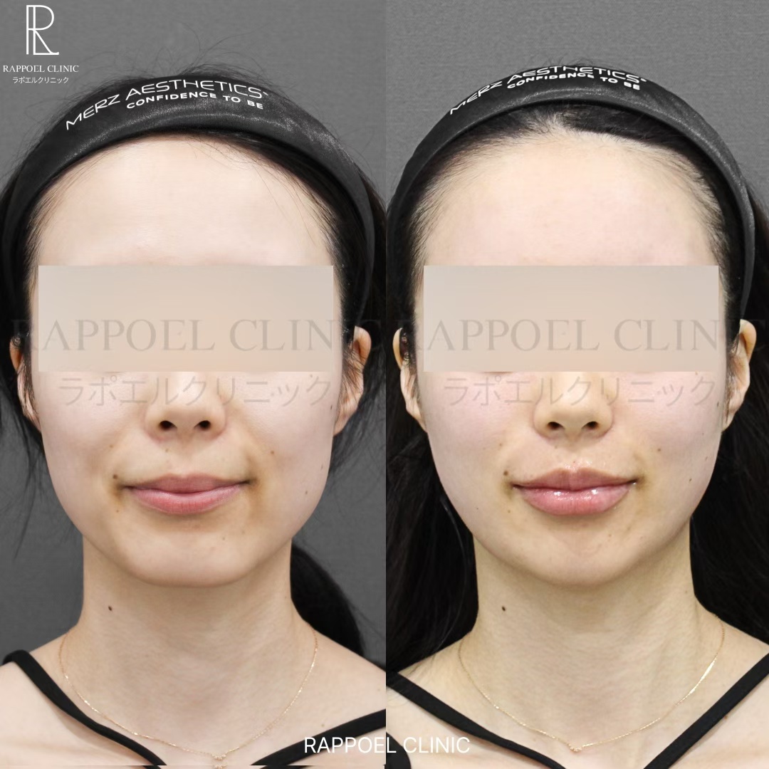 Lip filler before and after