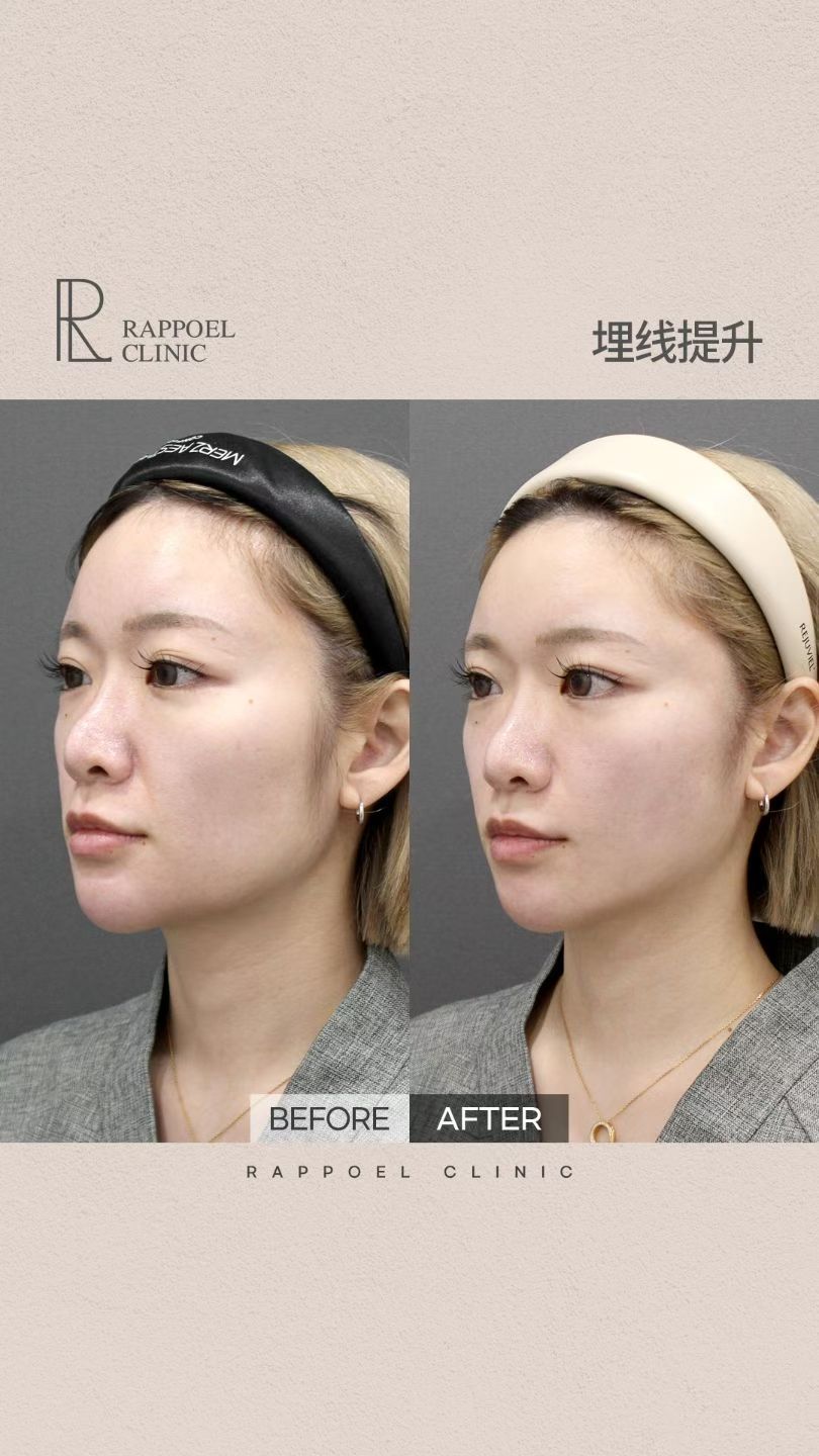 Botox wrinkle treatment
